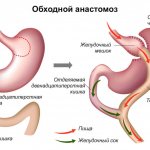 anastomositis after gastrectomy treatment