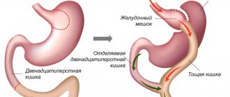 анастомозит после резекции желудка лечение