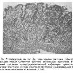 atrophic gastritis