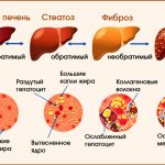 Cirrhosis of the liver