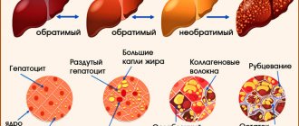 Cirrhosis of the liver