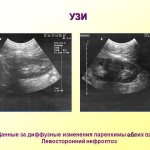 Diffuse changes in the parenchyma