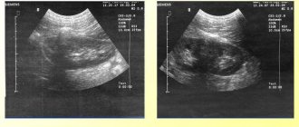 Diffuse changes in the parenchyma