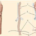 Esophageal diverticula