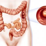 Endoscopic colon polypectomy