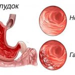 Гастрит очаги