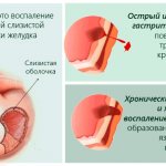 Gastritis