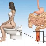 Hemorrhoids are a disease of the rectum, accompanied by the formation and prolapse of nodes