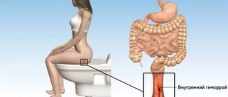 Hemorrhoids are a disease of the rectum, accompanied by the formation and prolapse of nodes