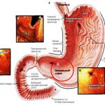 Hyperplasia of the antrum of the stomach