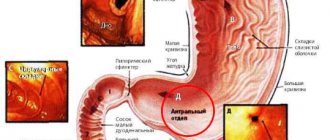 Hyperplasia of the antrum of the stomach