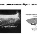 hypoechoic formations