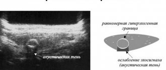 hypoechoic formations