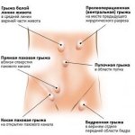 A hernia provokes dysfunction of the organs of the system where the hernial sac is located