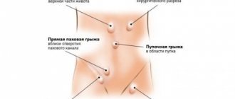 Грыжа провоцирует дисфункции органов той системы, где расположен грыжевой мешок