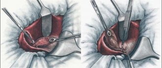 cholecystectomy of the gallbladder