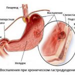 Chronic gastroduodenitis - symptoms and treatment