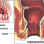 what does paraproctitis look like?