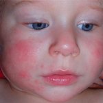 What diet for atopic dermatitis