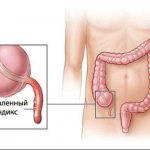 Treatment of appendicitis with folk remedies without surgery