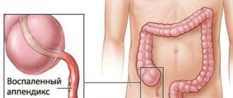 Treatment of appendicitis with folk remedies without surgery