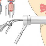 ligation