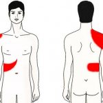 Localization of pain in cholecystitis