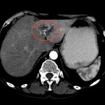 Focal formations of the liver