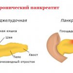 Pancreatitis in women