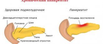 Pancreatitis in women