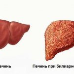 Liver with biliary cirrhosis