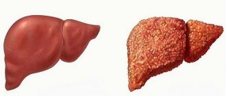 Liver with biliary cirrhosis