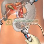 Postoperative period after removal of the gallbladder (laparoscopy), rehabilitation after treatment