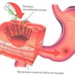 Causes of stomach bulbitis