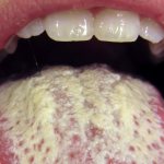 Causes and treatment of burning in the mouth and tongue