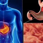 Cancer of the antrum of the stomach: features of the disease