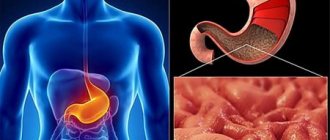 Cancer of the antrum of the stomach: features of the disease