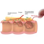 Rectal cancer is an oncological disease that is often fatal