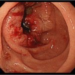 Sigmoid colon cancer - stages, symptoms and signs, treatment and diet