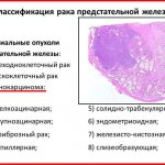 The division into types is based on changes in prostate tissue, as well as the stage of the lesion and the speed of spread.