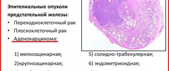 The division into types is based on changes in prostate tissue, as well as the stage of the lesion and the speed of spread.