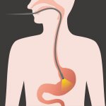 Scheme of gastroscopy