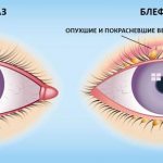 Symptoms of blepharitis