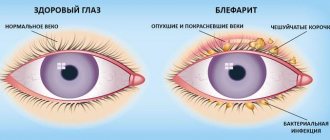 Symptoms of blepharitis