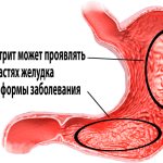 Mixed gastritis of the stomach