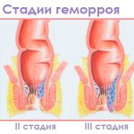 In medical practice, it is customary to distinguish 4 stages of hemorrhoids. This classification is relevant for internal hemorrhoids. When nodes are located externally, it is customary to take into account not the degree of their enlargement, but the presence or absence of complications. 