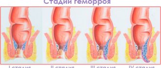 В медицинской практике принято выделять 4 стадии геморроя. Данная классификация актуальна для внутреннего геморроя. При наружном расположении узлов принято учитывать не степень их увеличения, а наличие или отсутствие осложнений.