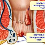 Виды геморроидальных узлов