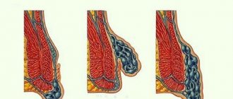 Types of hemorrhoids