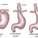 types of hiatal hernia